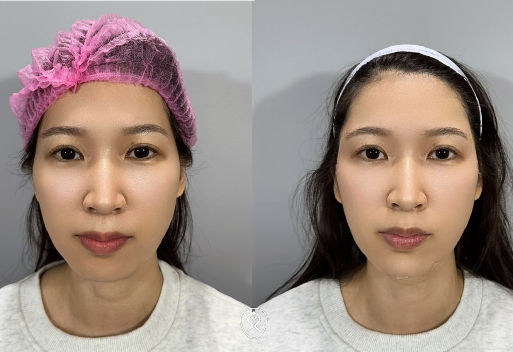 使用喬雅登玻尿酸填補夫妻宮凹陷讓臉部線條更加柔順